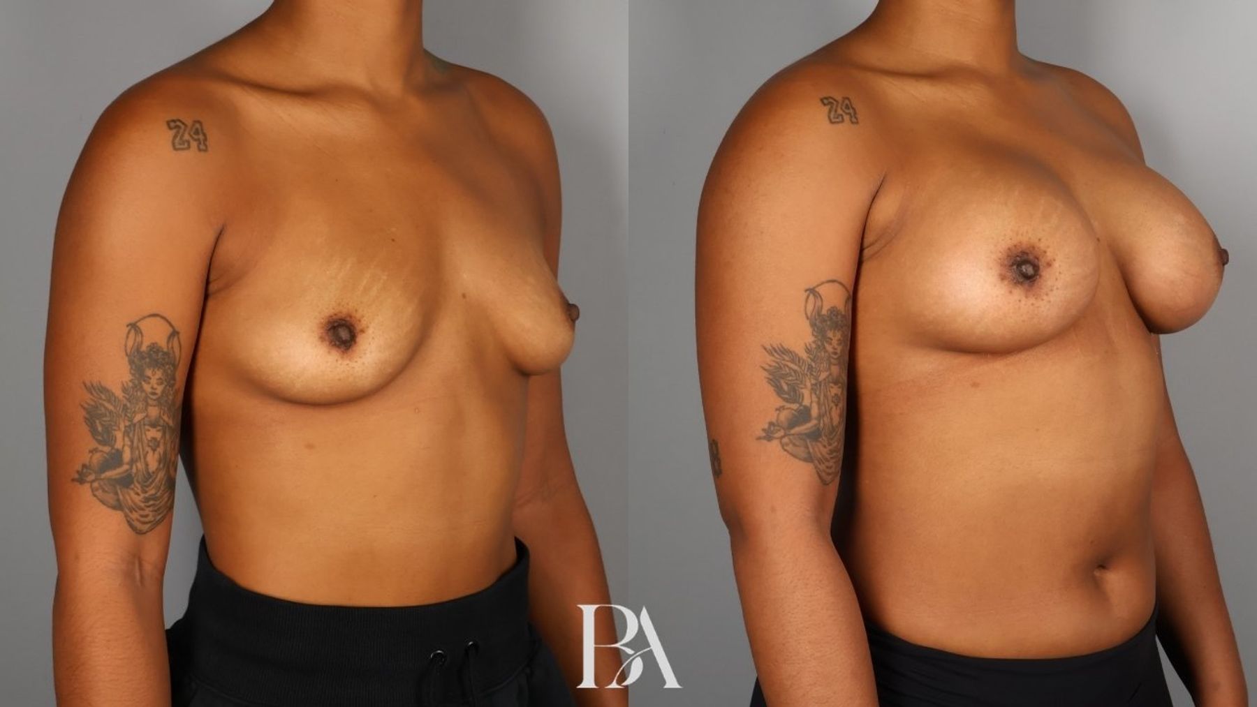 Breast augmentation before and after — oblique view, Dr. Beina Azadgoli, Beverly Hills