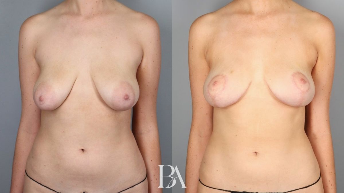 Before and after — Breast Lift (Mastopexy)