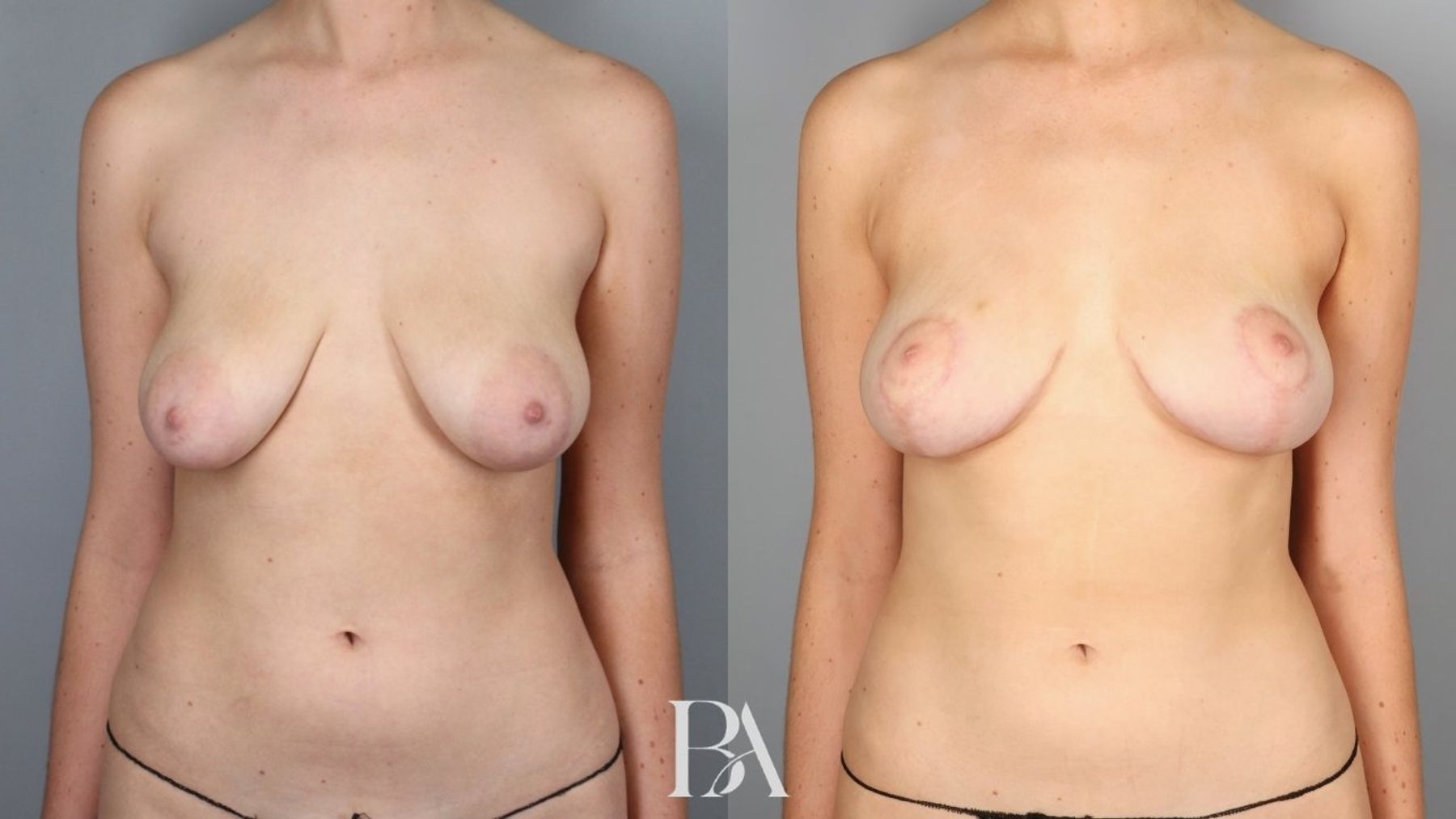 Breast lift before and after — front view, Dr. Beina Azadgoli, Beverly Hills