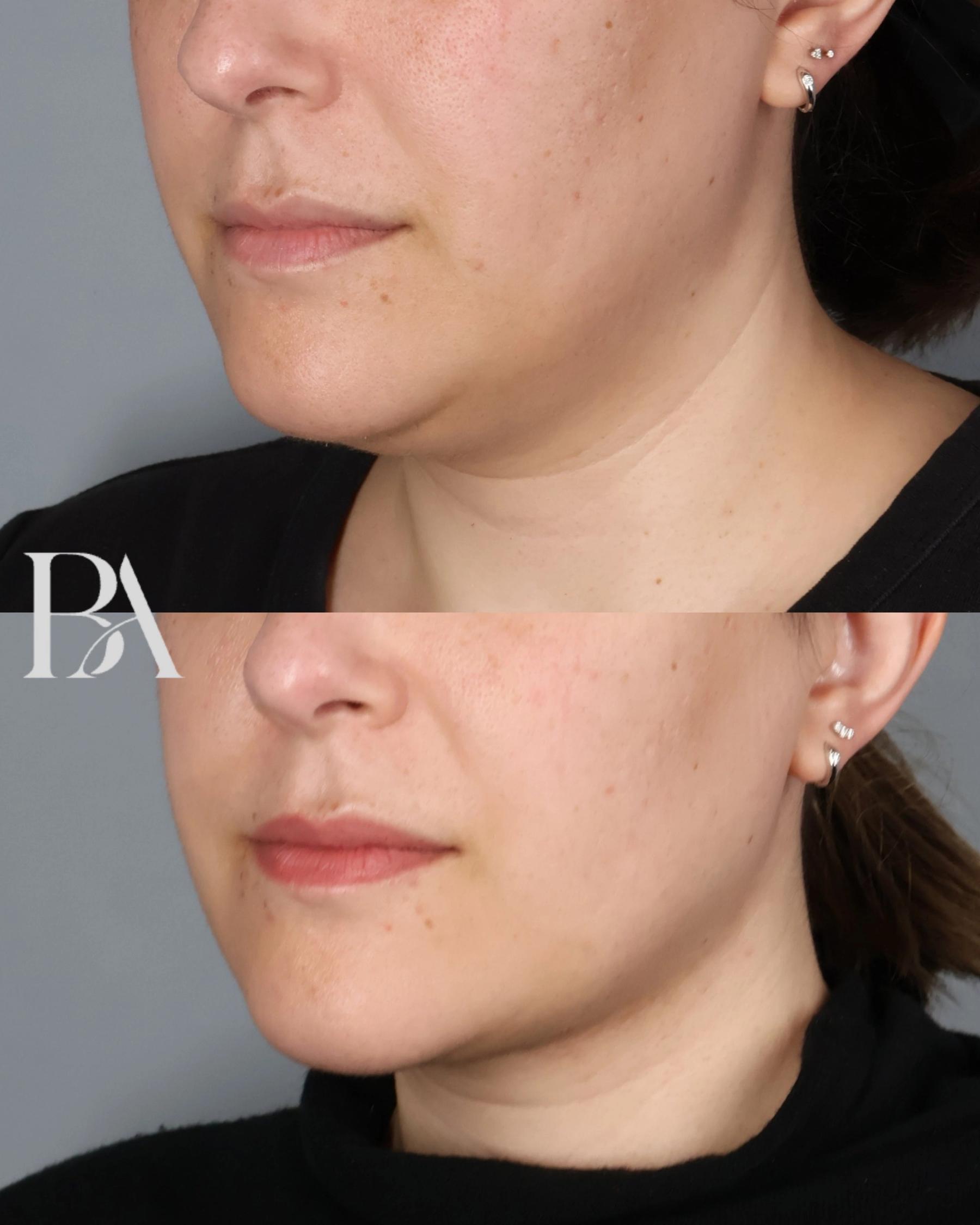 Submental Liposuction before and after — three-quarter view, Dr. Beina Azadgoli, Beverly Hills