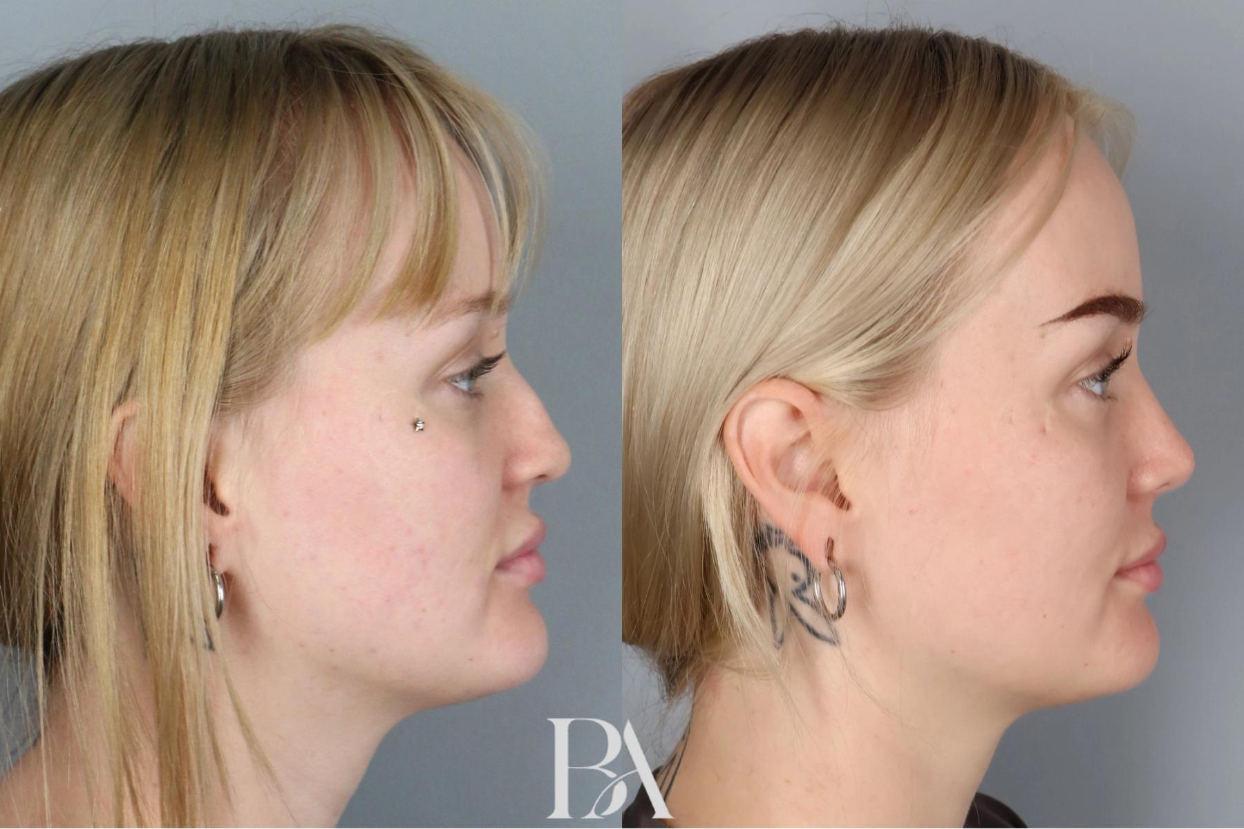 Rhinoplasty before and after — side view, Dr. Beina Azadgoli, Beverly Hills