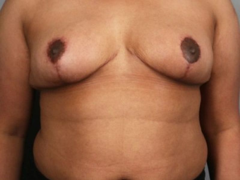 After — Breast Reduction