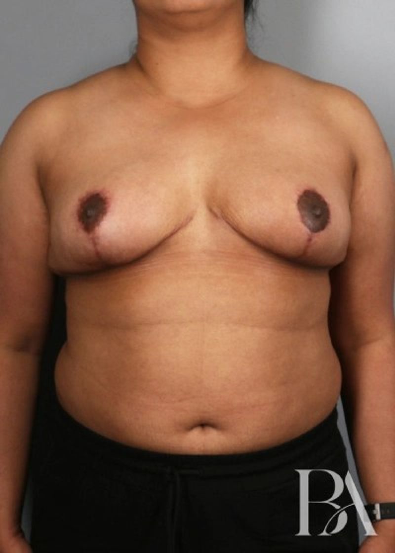 After — Breast Reduction