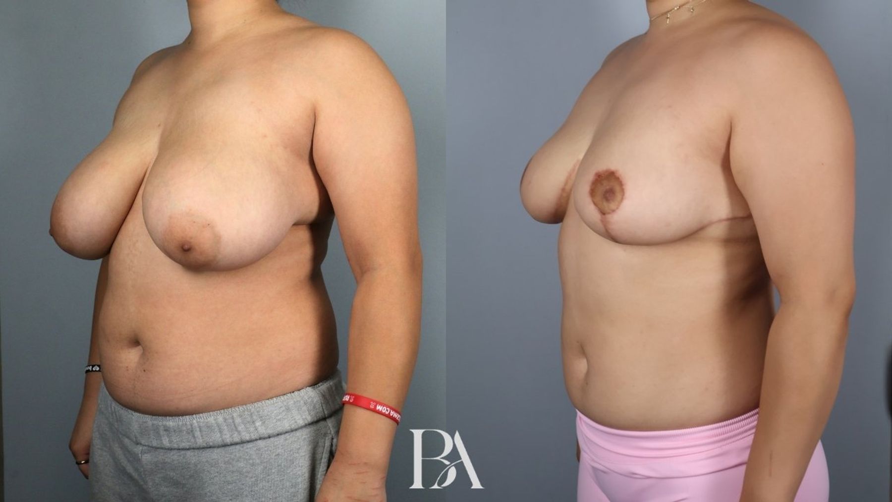 Breast reduction before and after — three-quarter view, Dr. Beina Azadgoli, Beverly Hills