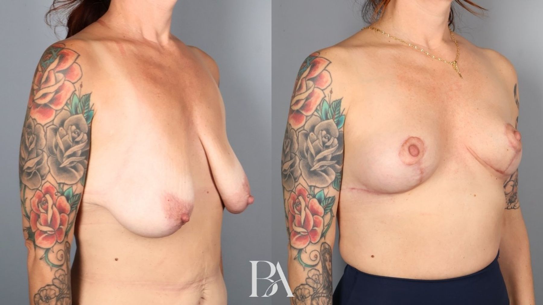 Breast lift before and after — oblique view, Dr. Beina Azadgoli, Beverly Hills