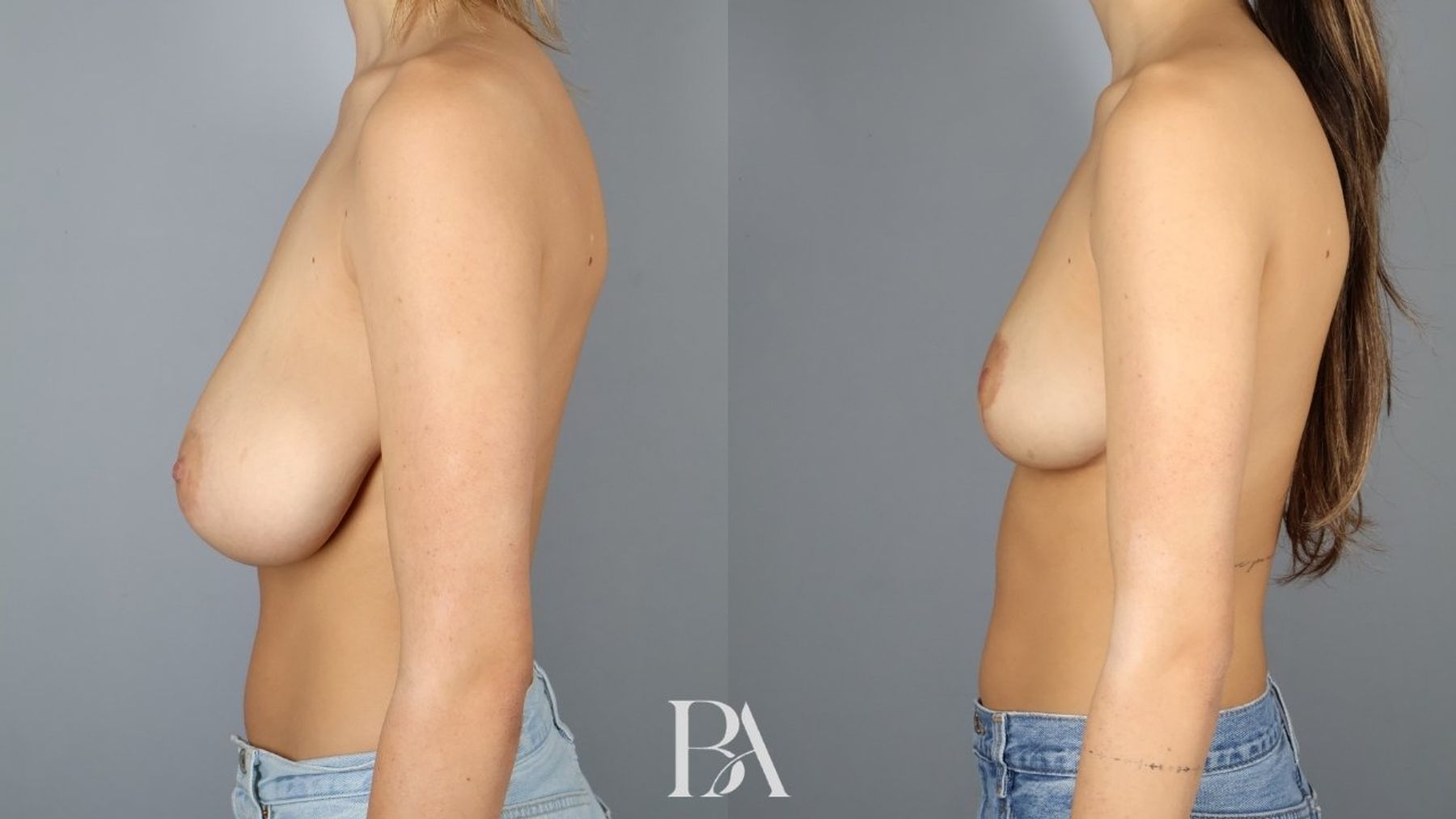 Breast reduction before and after — side view, Dr. Beina Azadgoli, Beverly Hills