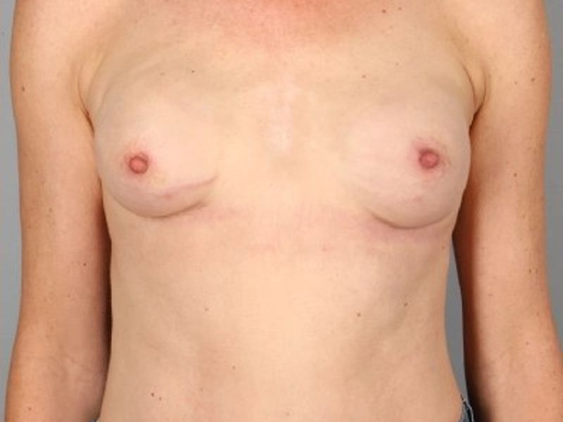 After — Direct-to-Implant Reconstruction