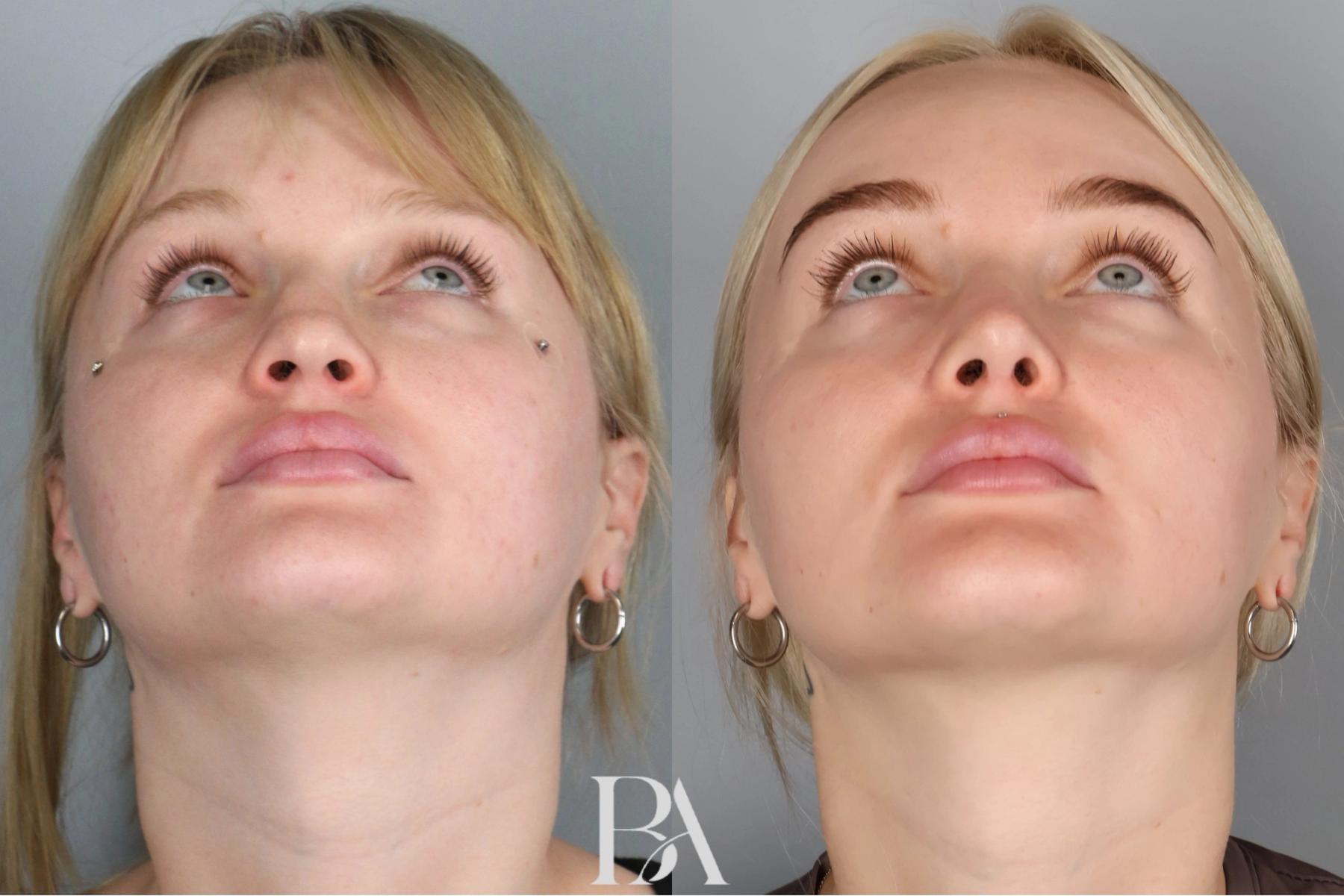 Rhinoplasty before and after — detail view, Dr. Beina Azadgoli, Beverly Hills