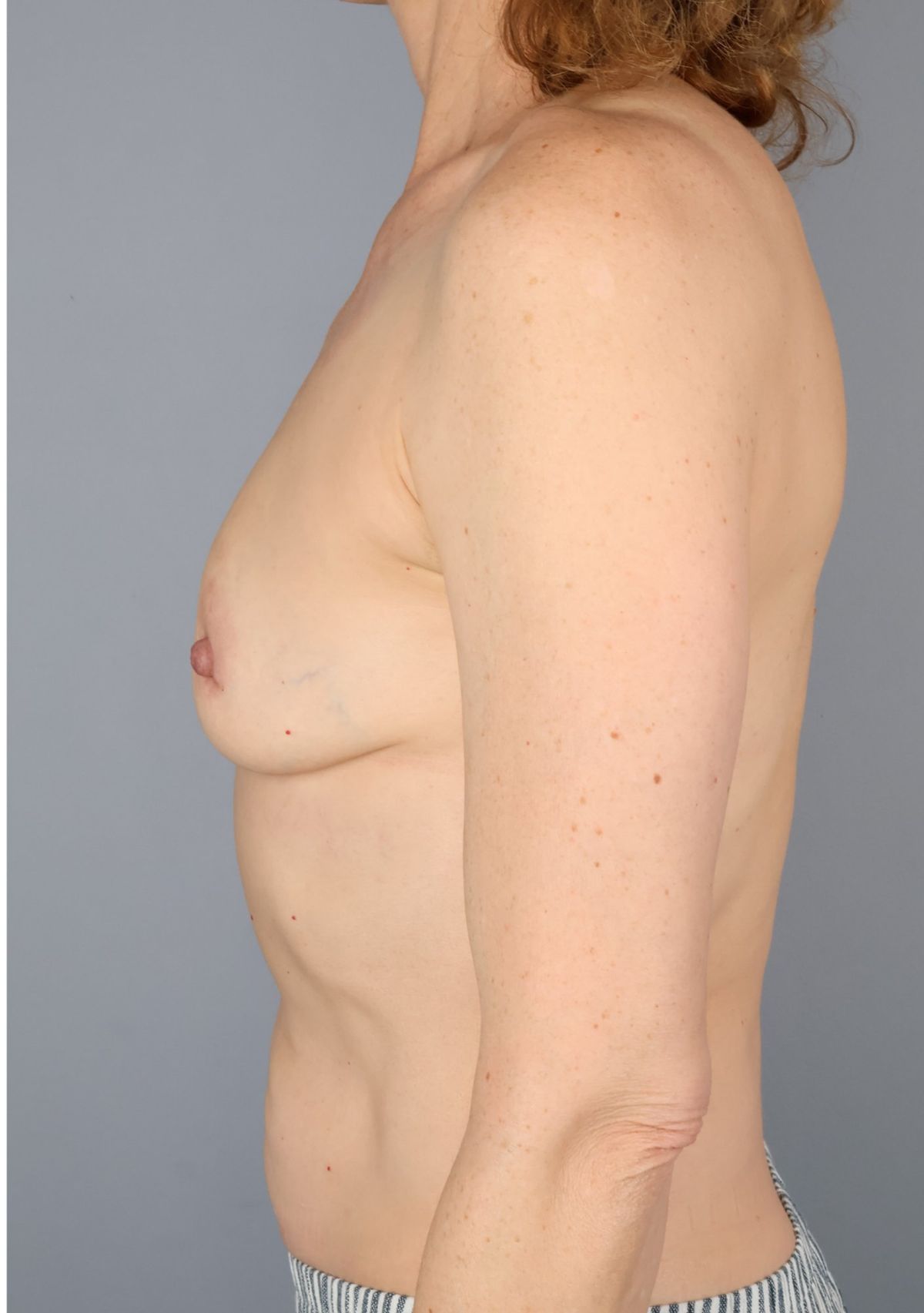 Direct-to-implant reconstruction before — side view, Dr. Beina Azadgoli, Beverly Hills