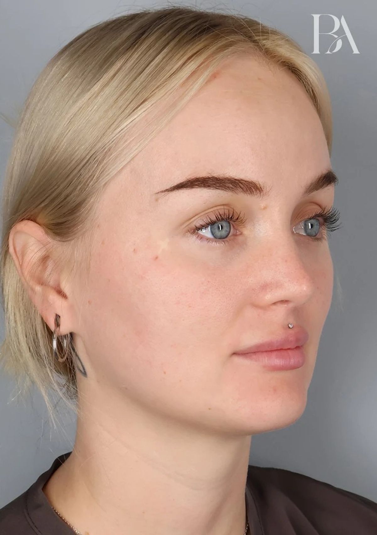 Case 3001 — Oblique after