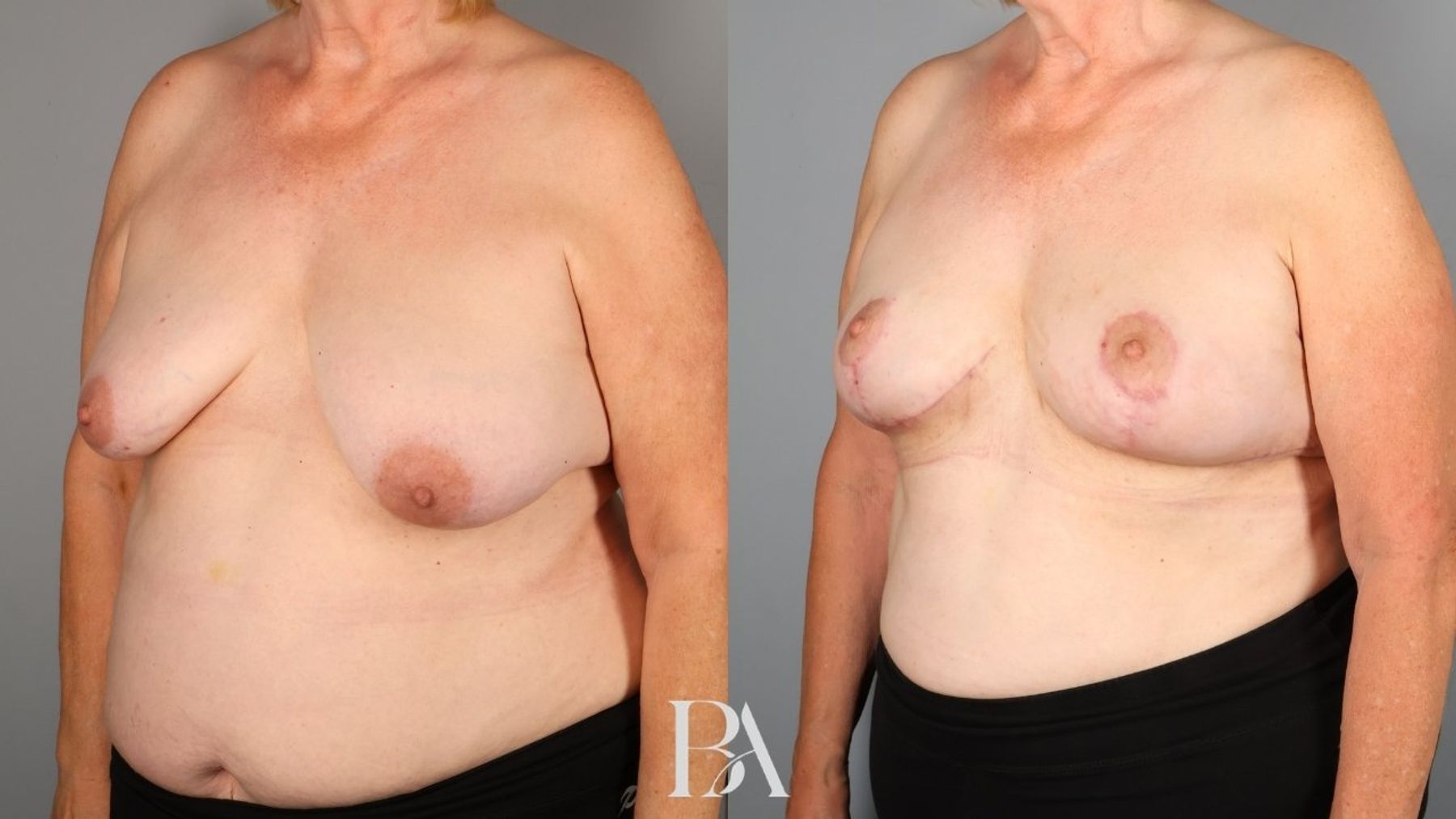 Oncoplastic Reduction before and after — three-quarter view, Dr. Beina Azadgoli, Beverly Hills