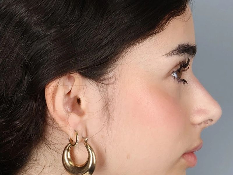 After — Rhinoplasty