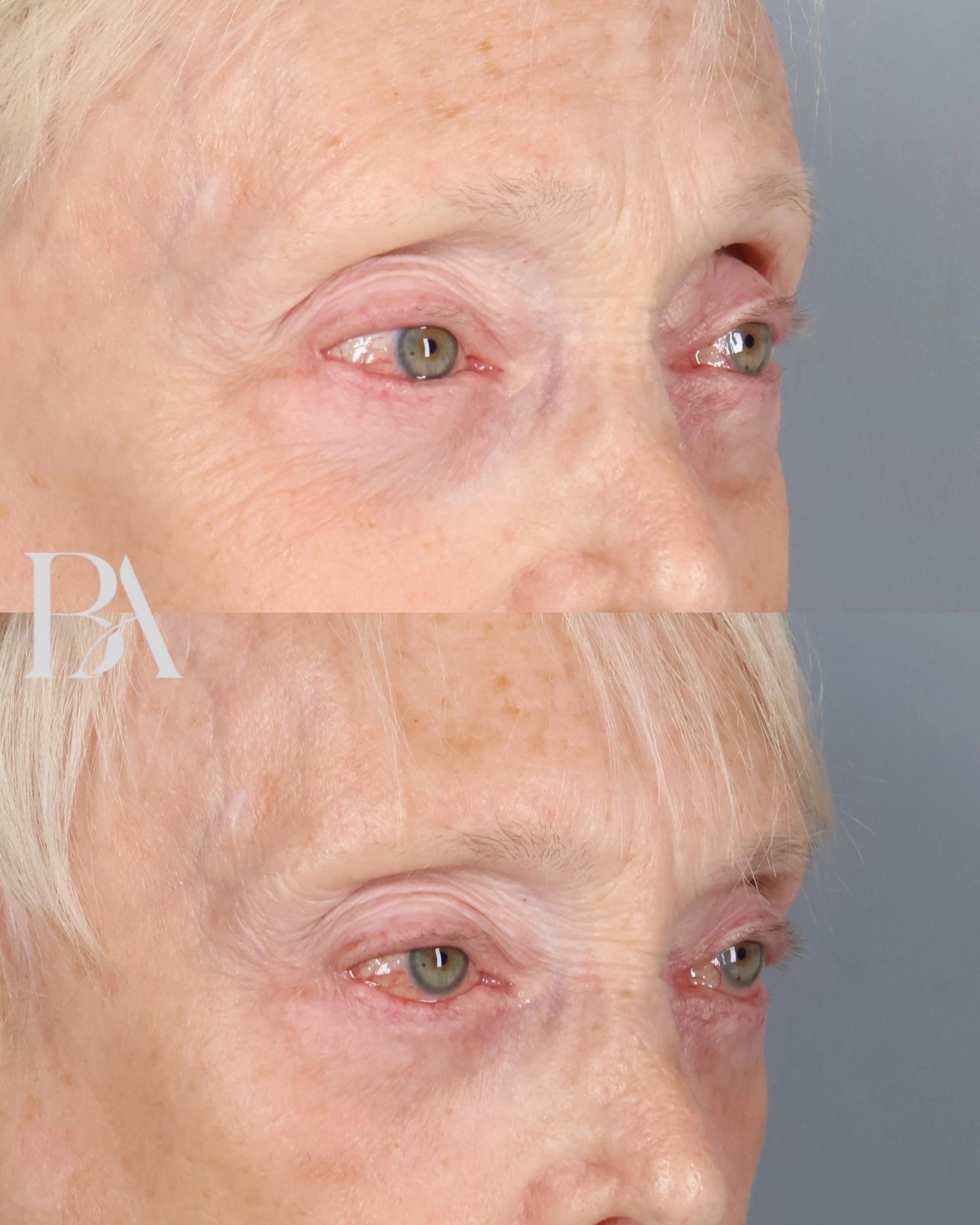 Lower Blepharoplasty before and after — oblique view, Dr. Beina Azadgoli, Beverly Hills