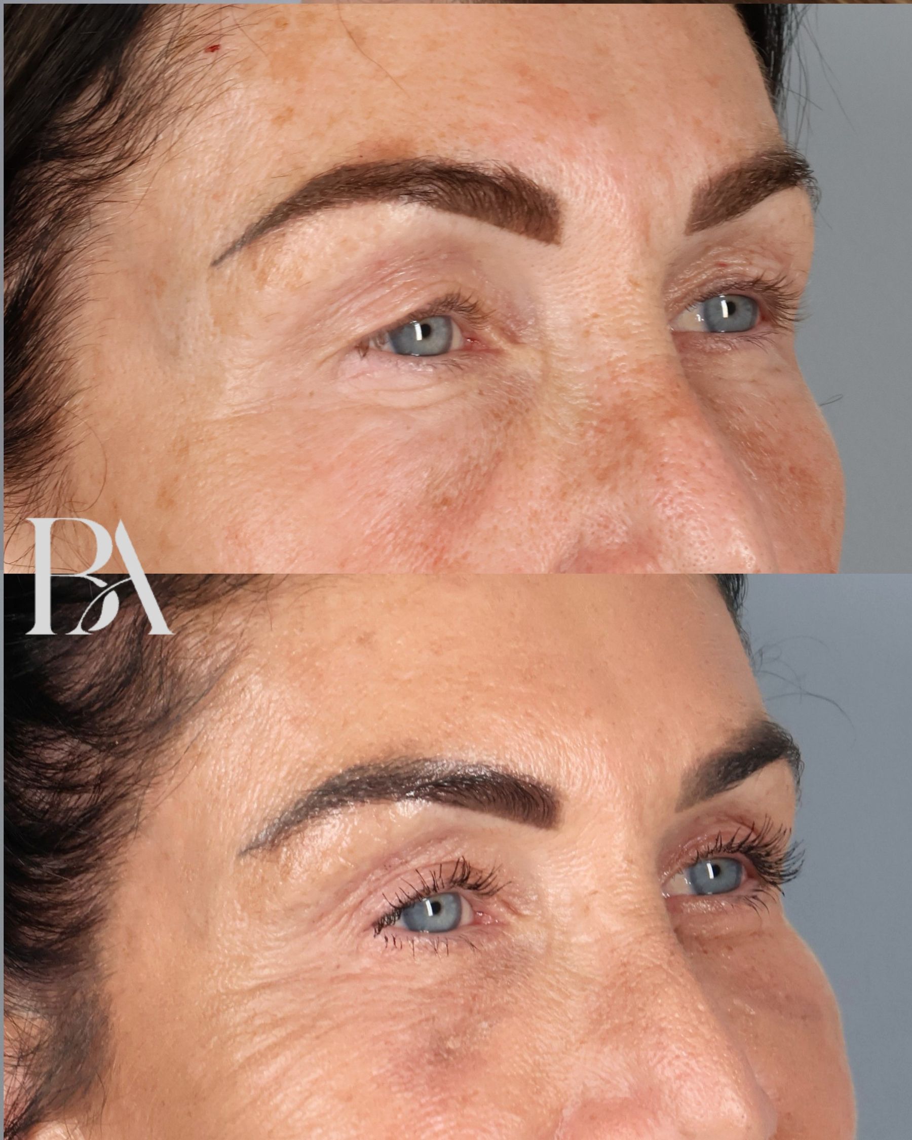Upper Blepharoplasty before and after — oblique view, Dr. Beina Azadgoli, Beverly Hills