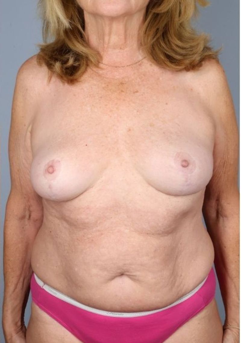 After — Breast Implant Removal (+/- Lift)