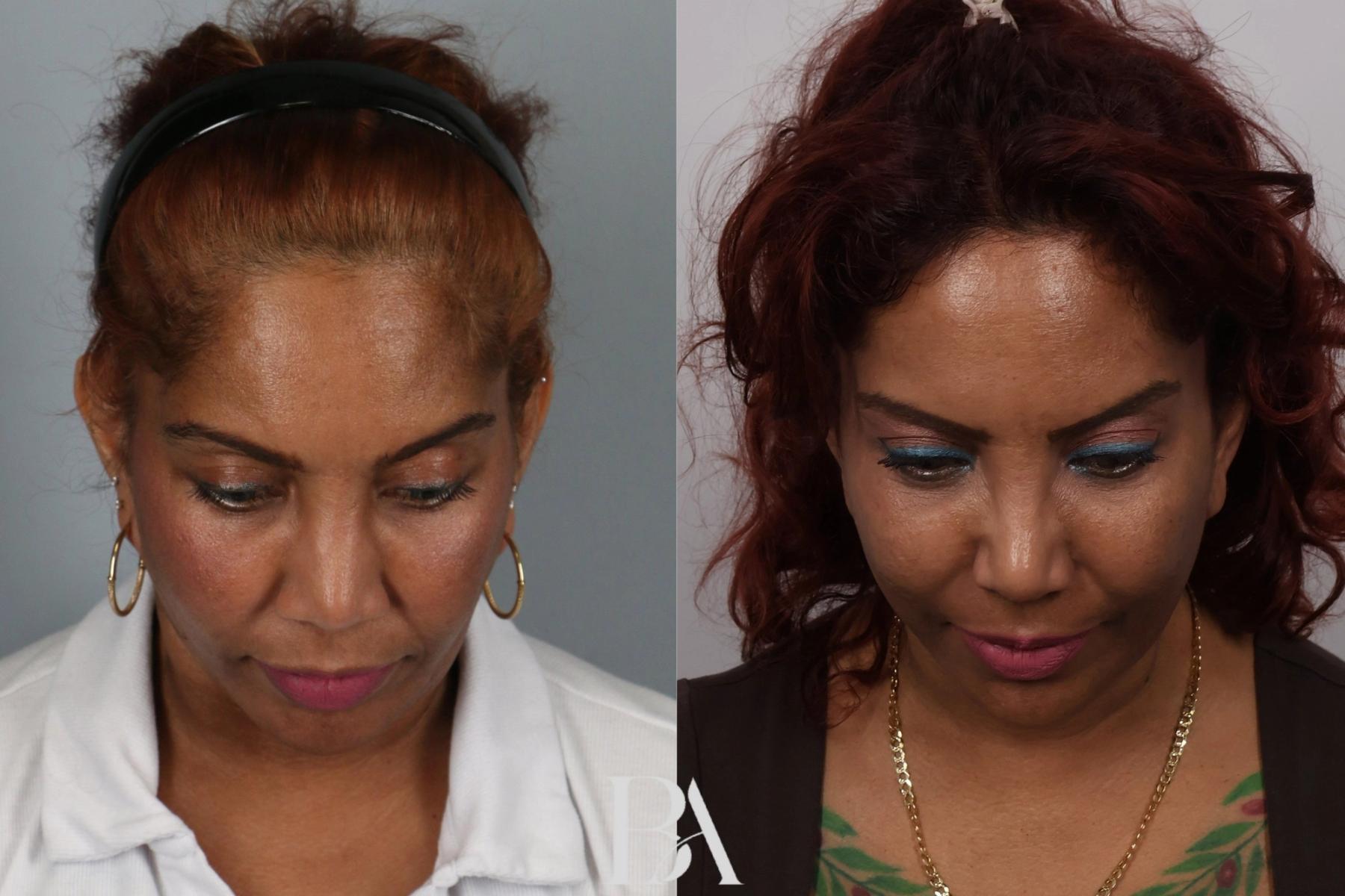 Rhinoplasty before and after — detail view, Dr. Beina Azadgoli, Beverly Hills