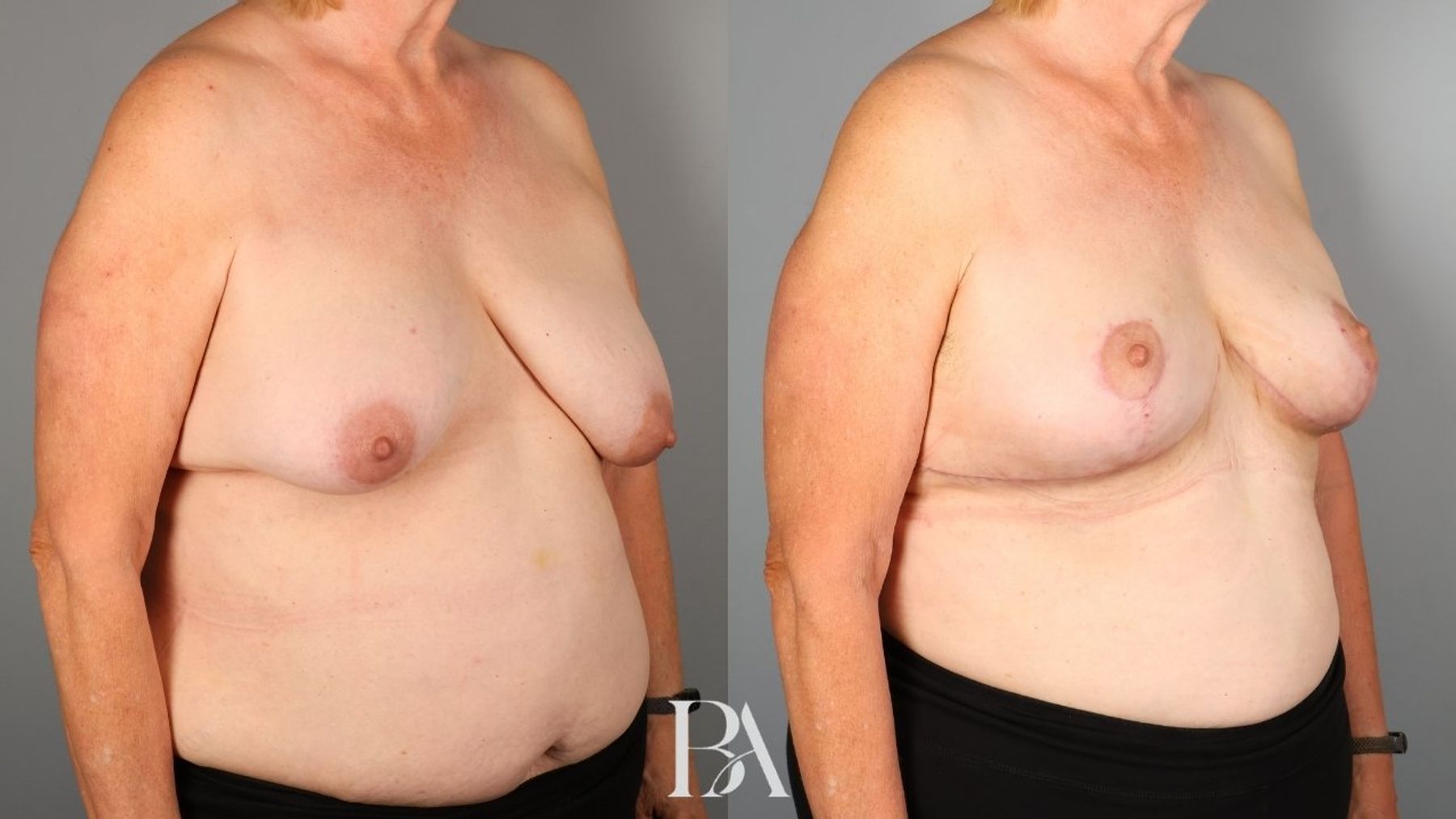 Oncoplastic Reduction before and after — oblique view, Dr. Beina Azadgoli, Beverly Hills