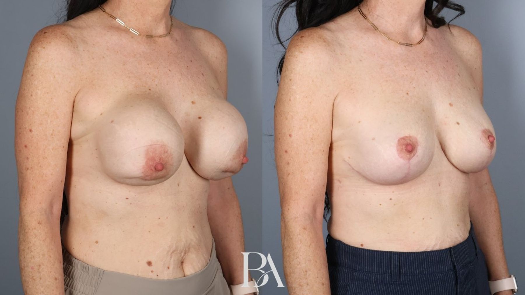 Implant Removal and Replacement before and after — oblique view, Dr. Beina Azadgoli, Beverly Hills
