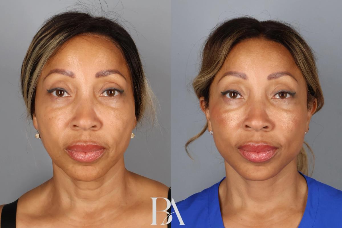 Face/Neck Lift before and after — front view, Dr. Beina Azadgoli, Beverly Hills