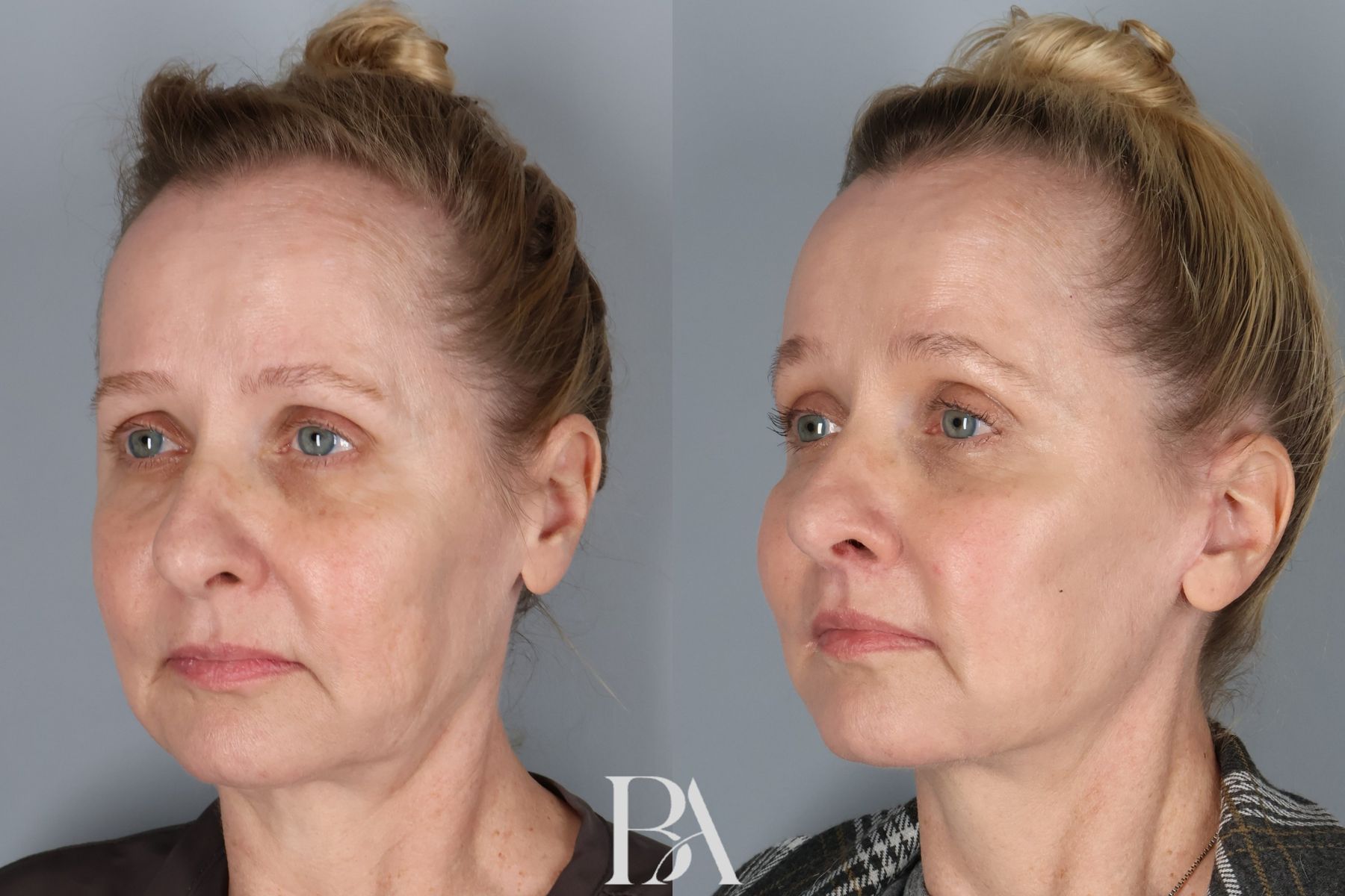 Face/Neck Lift before and after — three-quarter view, Dr. Beina Azadgoli, Beverly Hills
