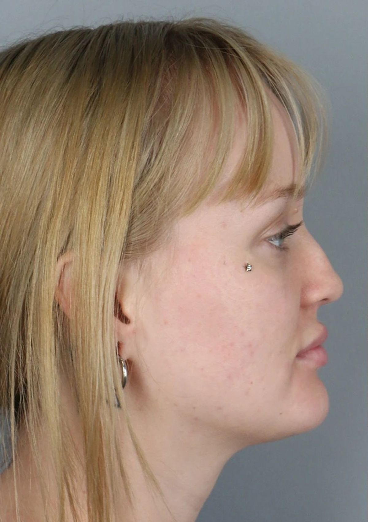 Case 3001 — Side before