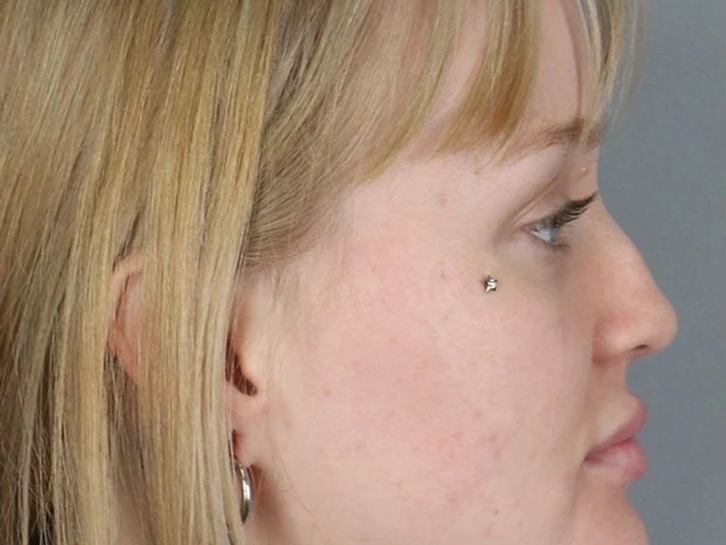 Before — Rhinoplasty