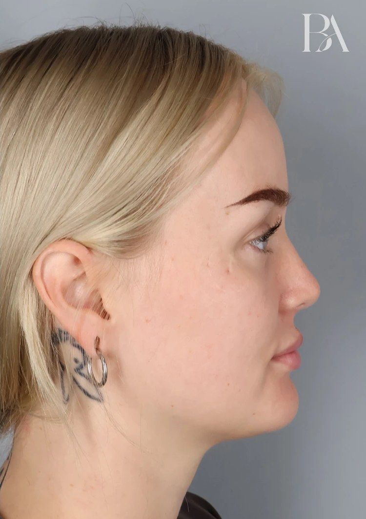 After — Rhinoplasty