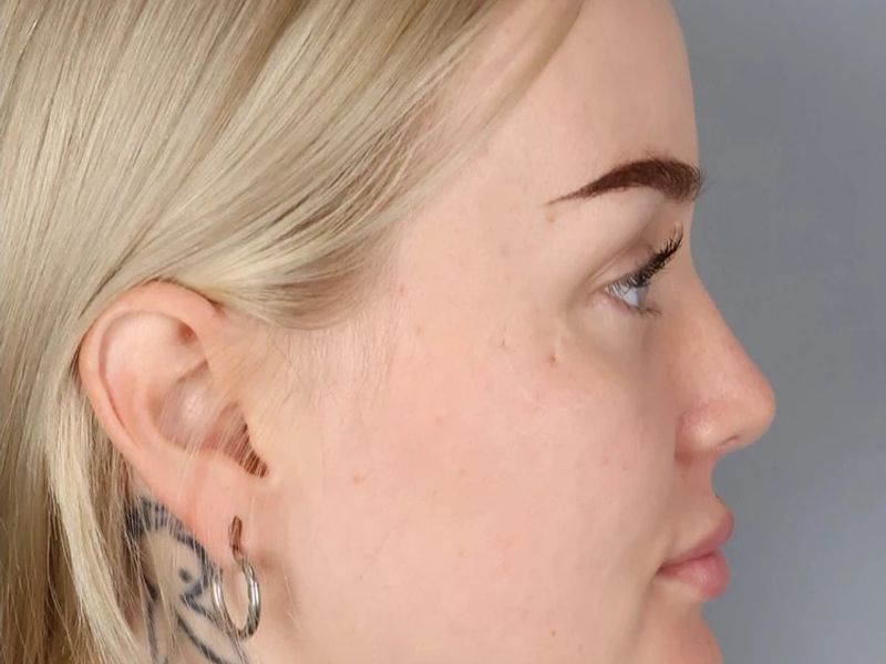 After — Rhinoplasty