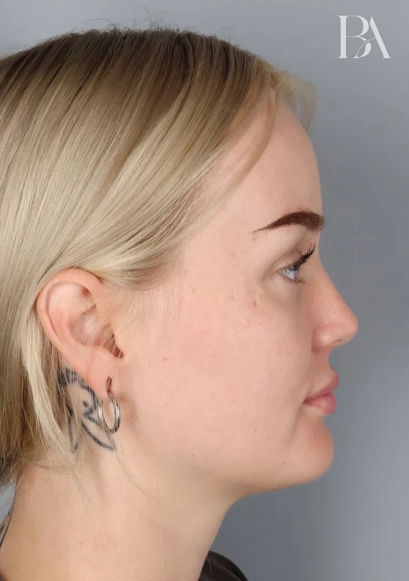 After — Rhinoplasty