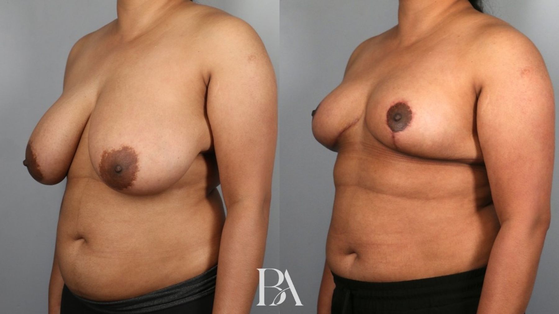 Breast reduction before and after — three-quarter view, Dr. Beina Azadgoli, Beverly Hills