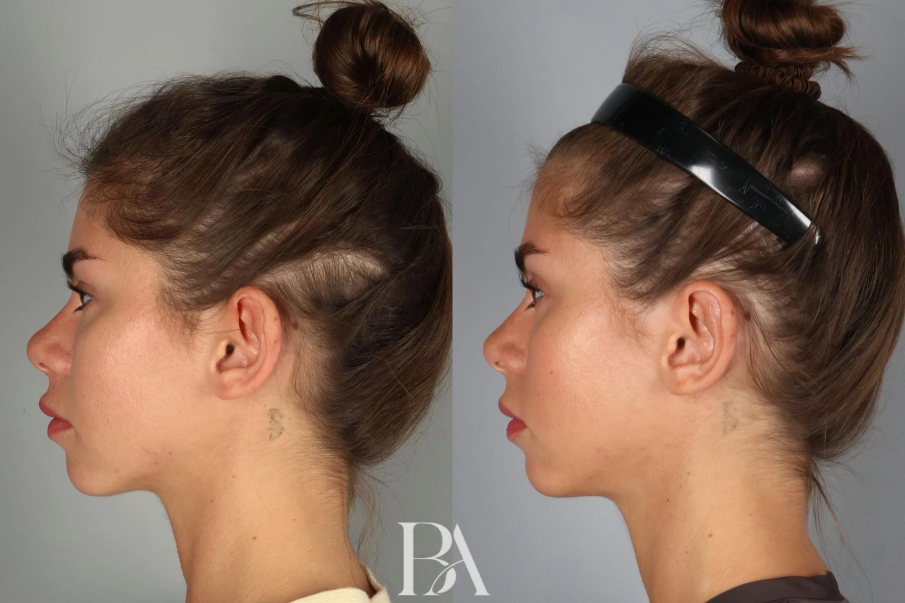 Ear Pinning before and after — side view, Dr. Beina Azadgoli, Beverly Hills