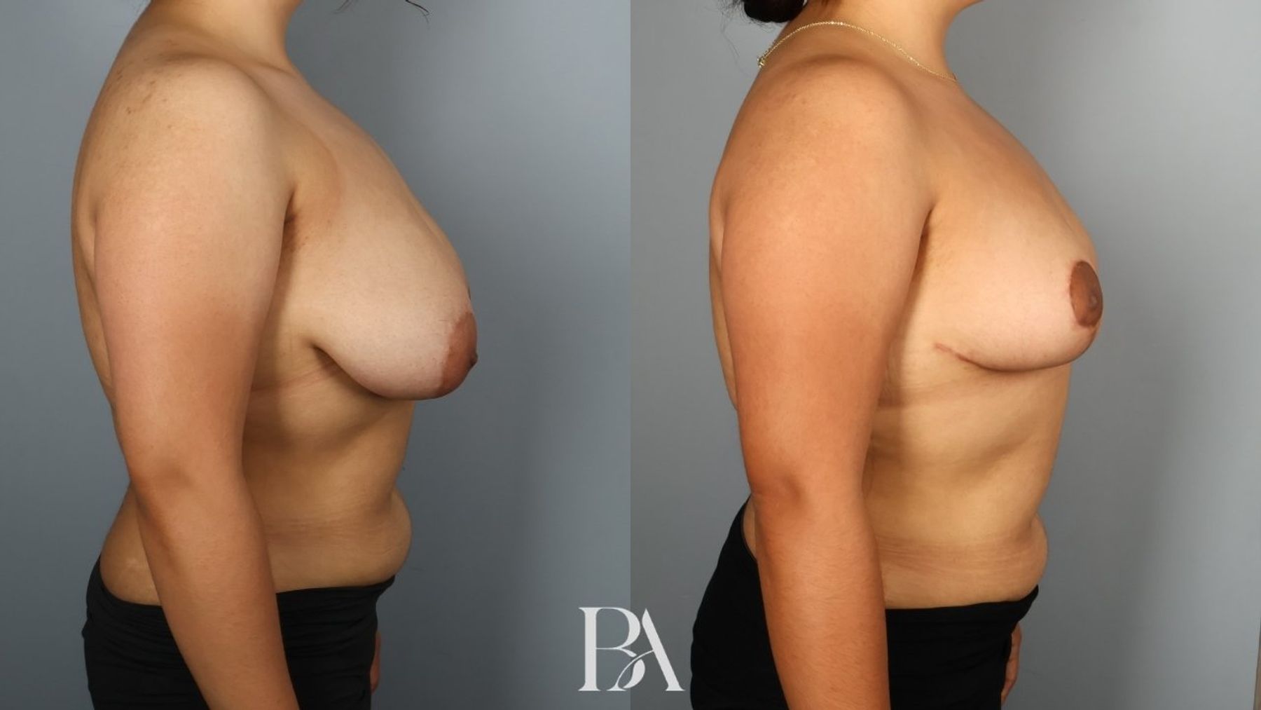 Breast reduction before and after — side view, Dr. Beina Azadgoli, Beverly Hills
