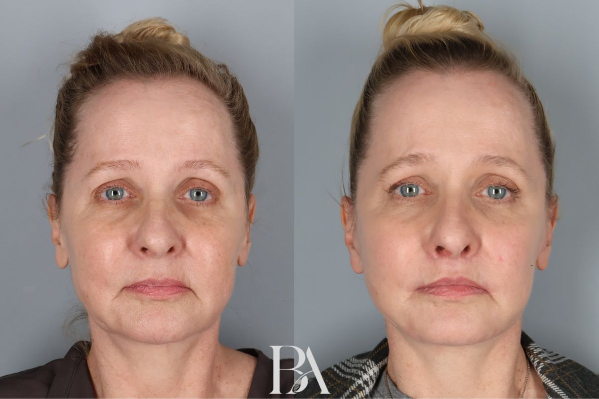 Face/Neck Lift before and after — front view, Dr. Beina Azadgoli, Beverly Hills