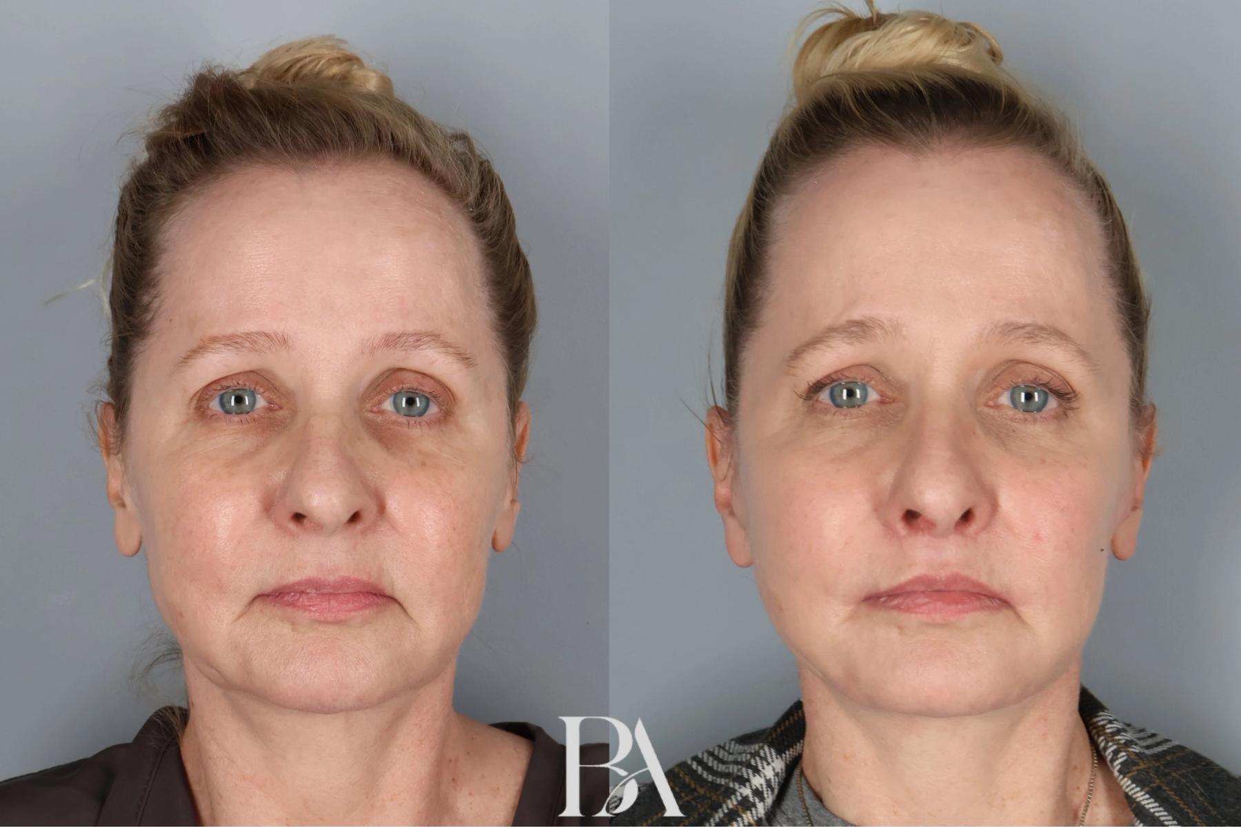 Face/Neck Lift before and after — front view, Dr. Beina Azadgoli, Beverly Hills