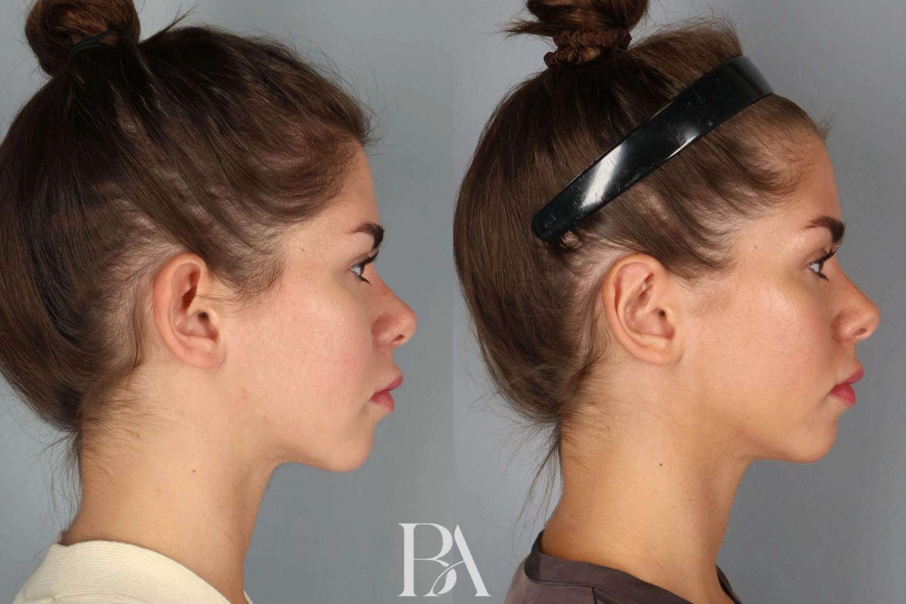 Ear Pinning before and after — side view, Dr. Beina Azadgoli, Beverly Hills