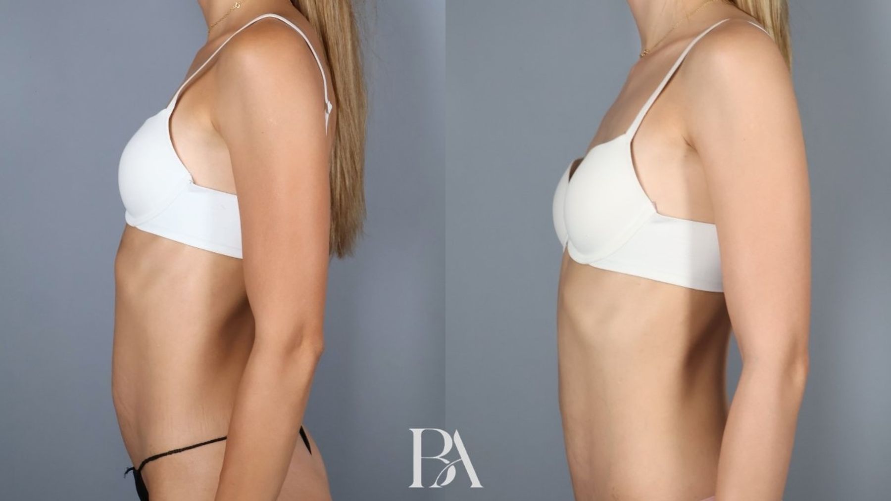 Tummy tuck before and after — side view, Dr. Beina Azadgoli, Beverly Hills