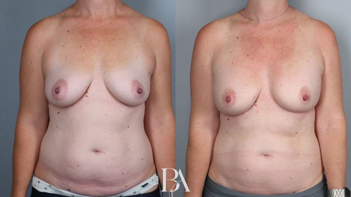 Before and after — Direct-to-Implant Reconstruction