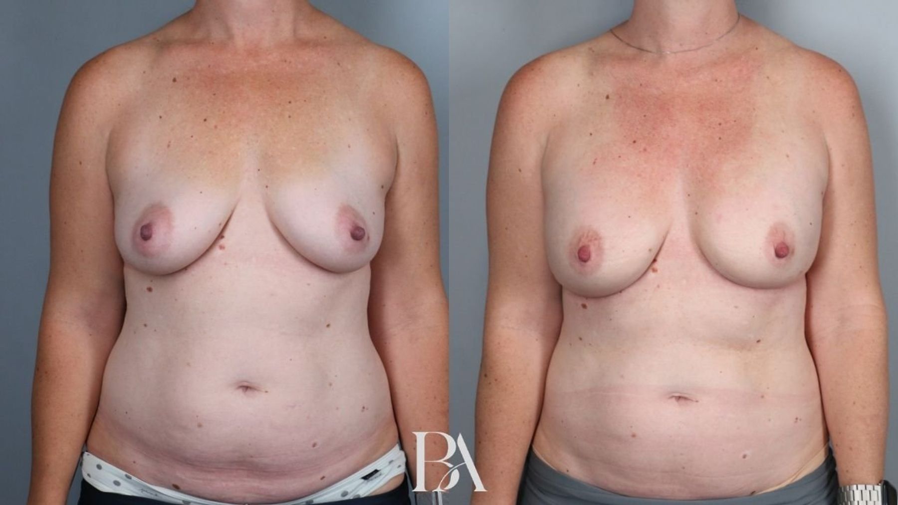 Direct-to-Implant Reconstruction before and after — front view, Dr. Beina Azadgoli, Beverly Hills