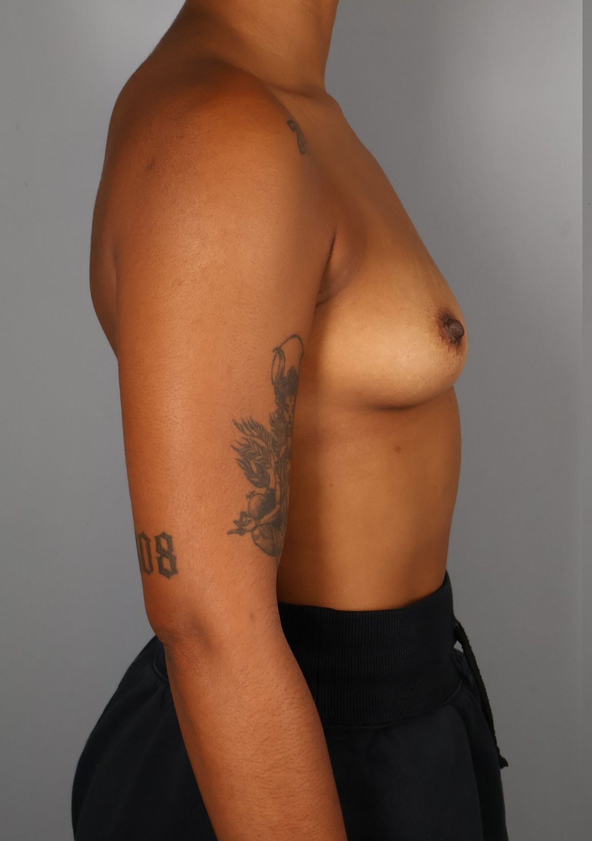 Breast augmentation before — detail view, Dr. Beina Azadgoli, Beverly Hills