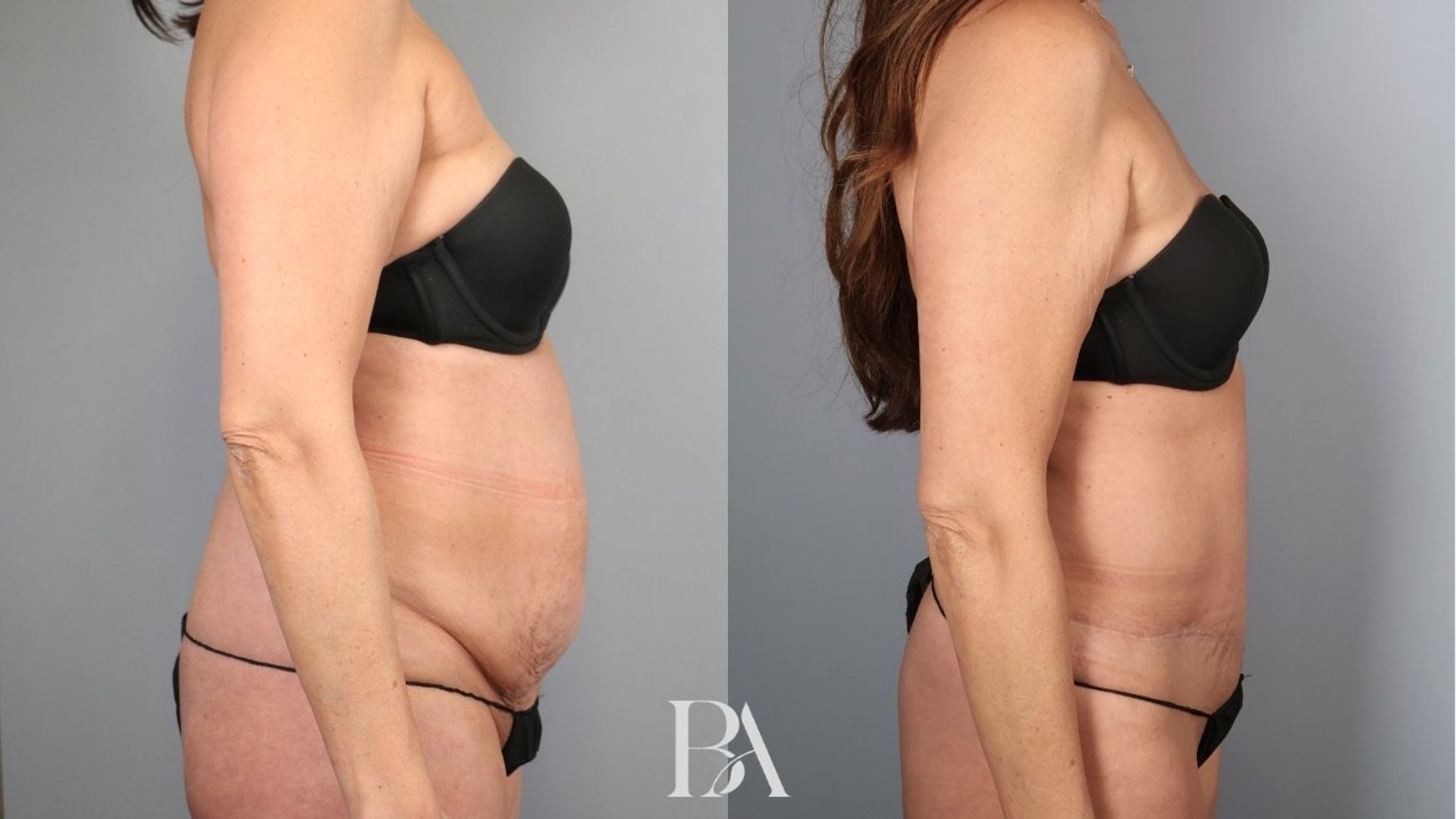 Tummy tuck before and after — side view, Dr. Beina Azadgoli, Beverly Hills