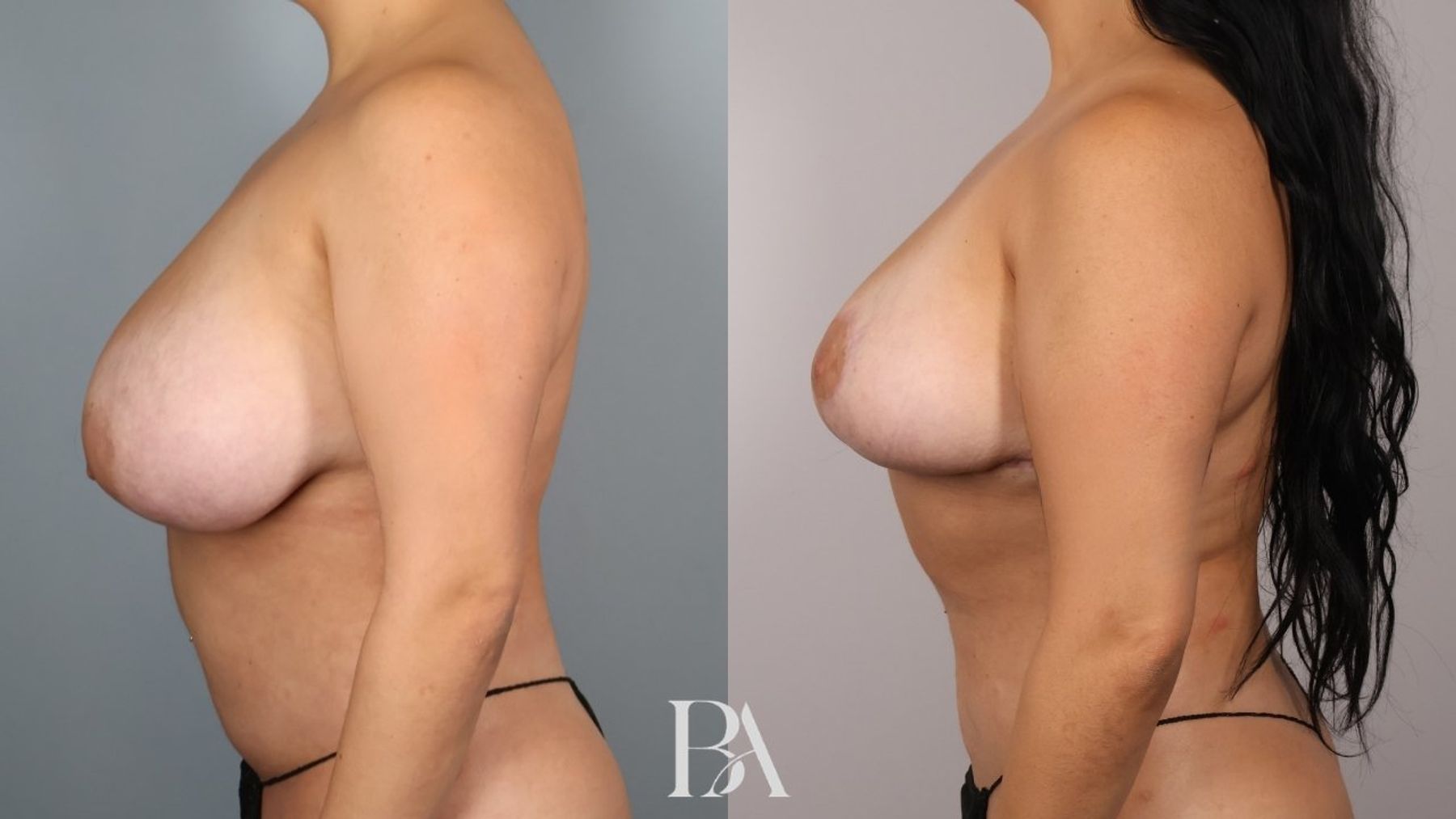 Breast reduction before and after — side view, Dr. Beina Azadgoli, Beverly Hills
