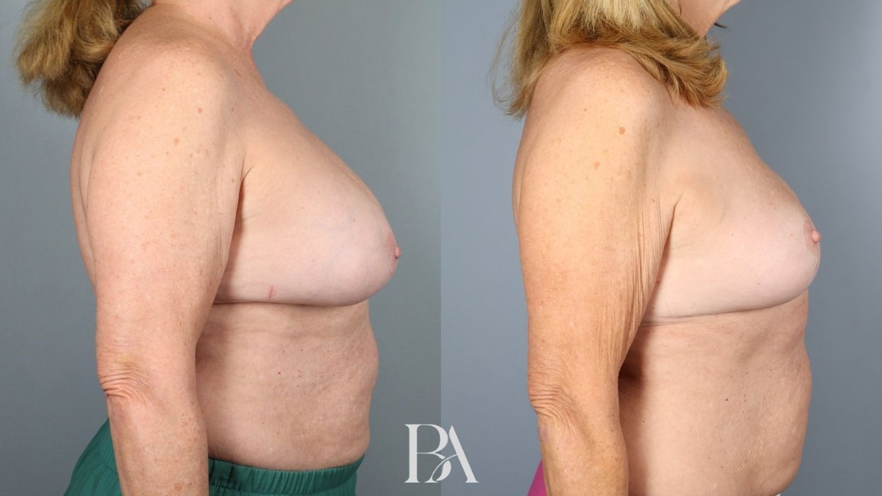 Breast implant removal before and after — side view, Dr. Beina Azadgoli, Beverly Hills