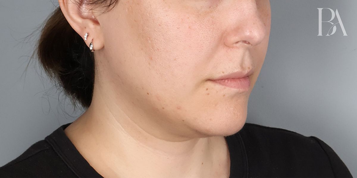 Submental liposuction before — oblique view, Dr. Beina Azadgoli, Beverly Hills