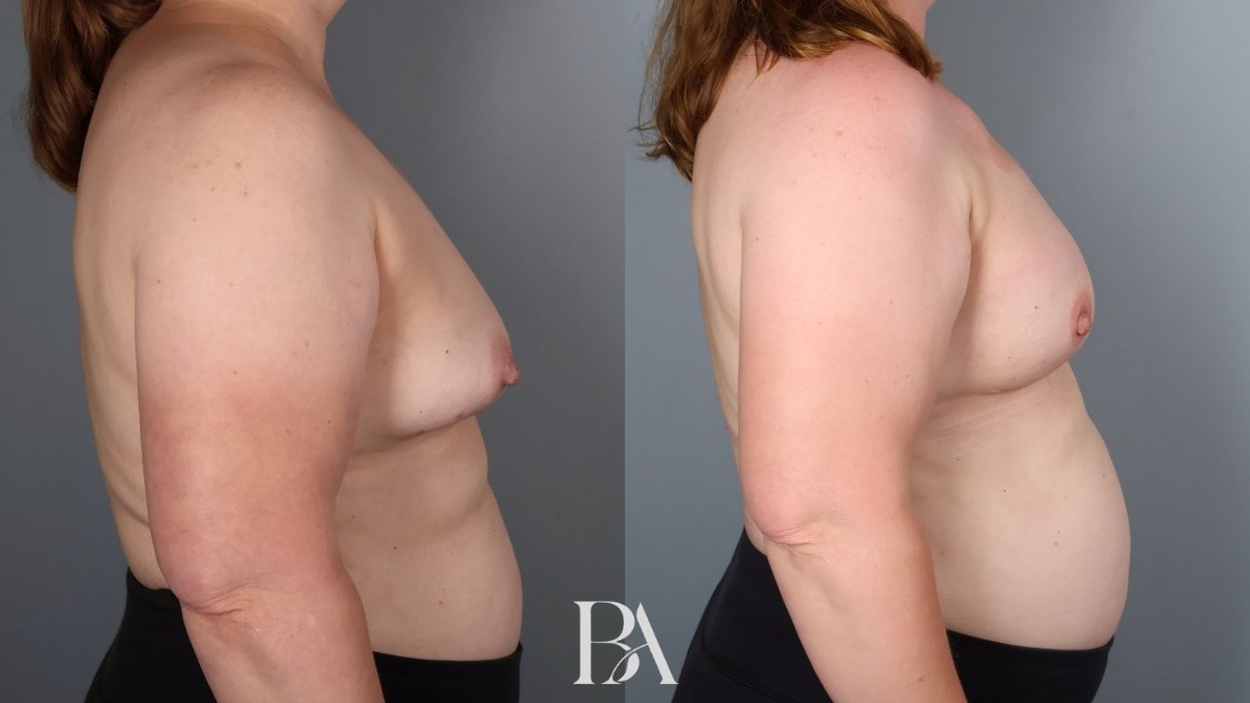 Direct-to-Implant Reconstruction before and after — side view, Dr. Beina Azadgoli, Beverly Hills