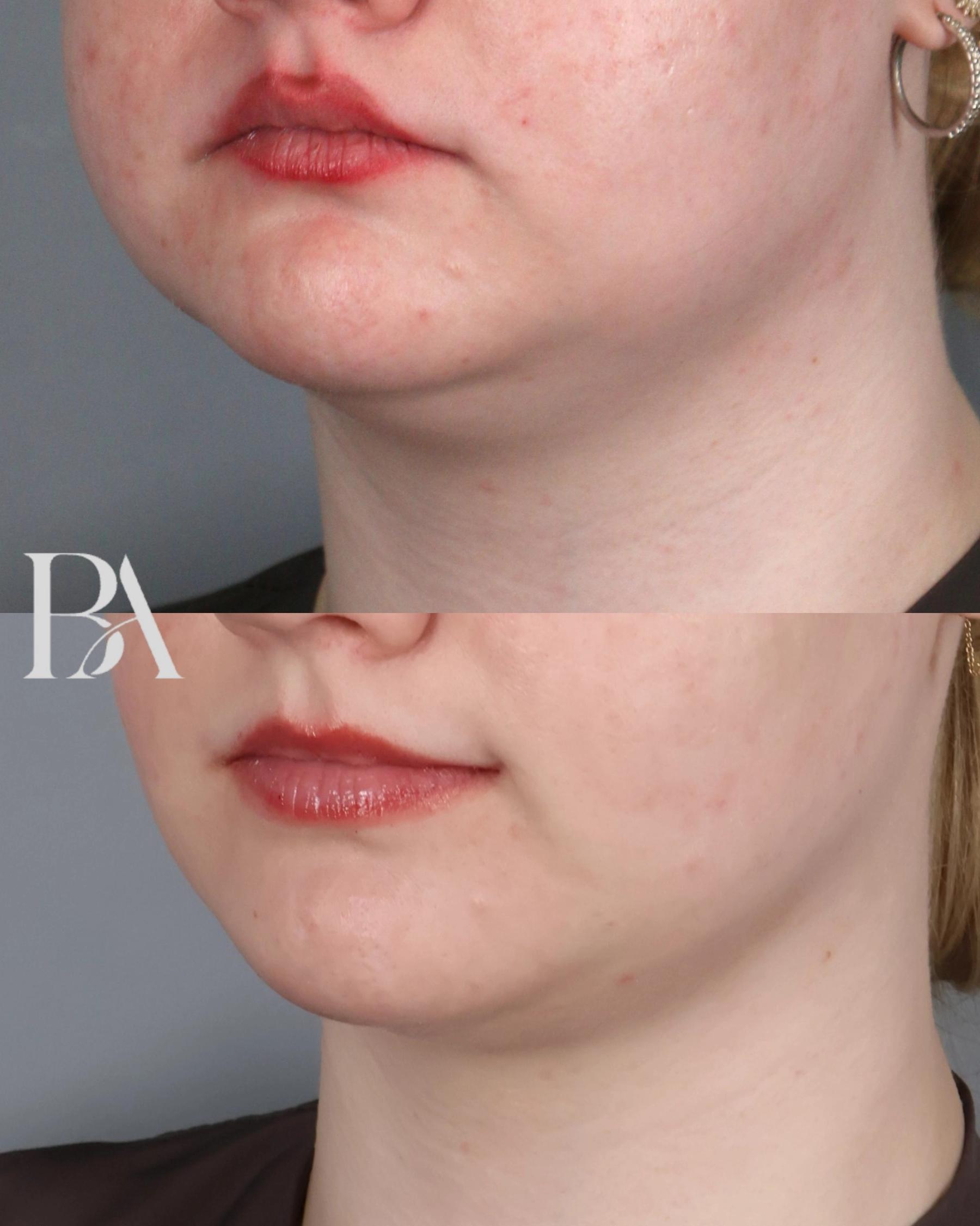Submental Liposuction before and after — three-quarter view, Dr. Beina Azadgoli, Beverly Hills