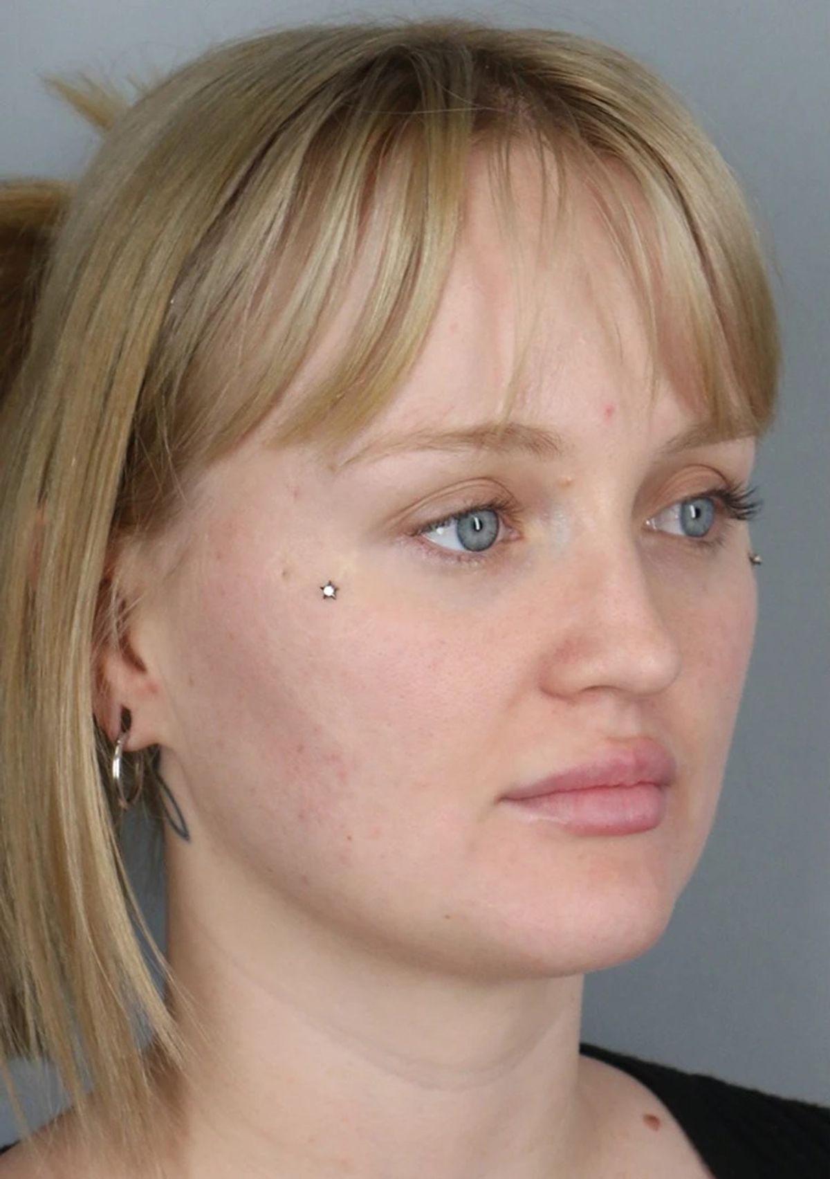 Case 3001 — Oblique before