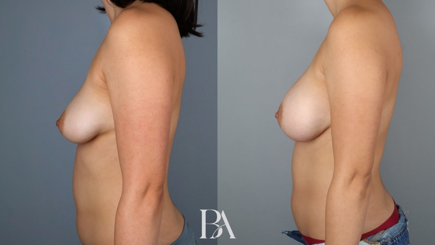 Breast augmentation before and after — side view, Dr. Beina Azadgoli, Beverly Hills