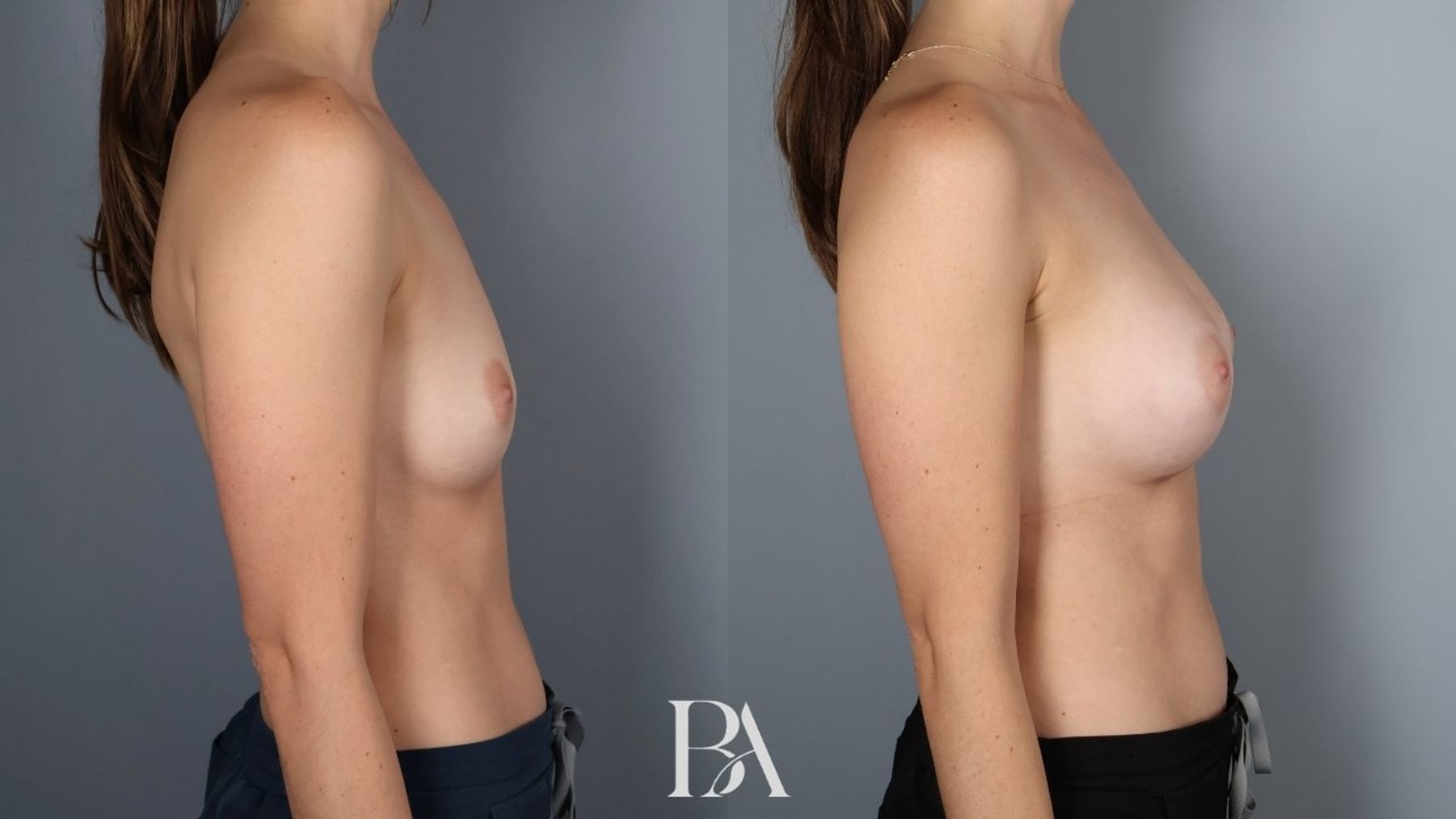 Breast augmentation before and after — side view, Dr. Beina Azadgoli, Beverly Hills