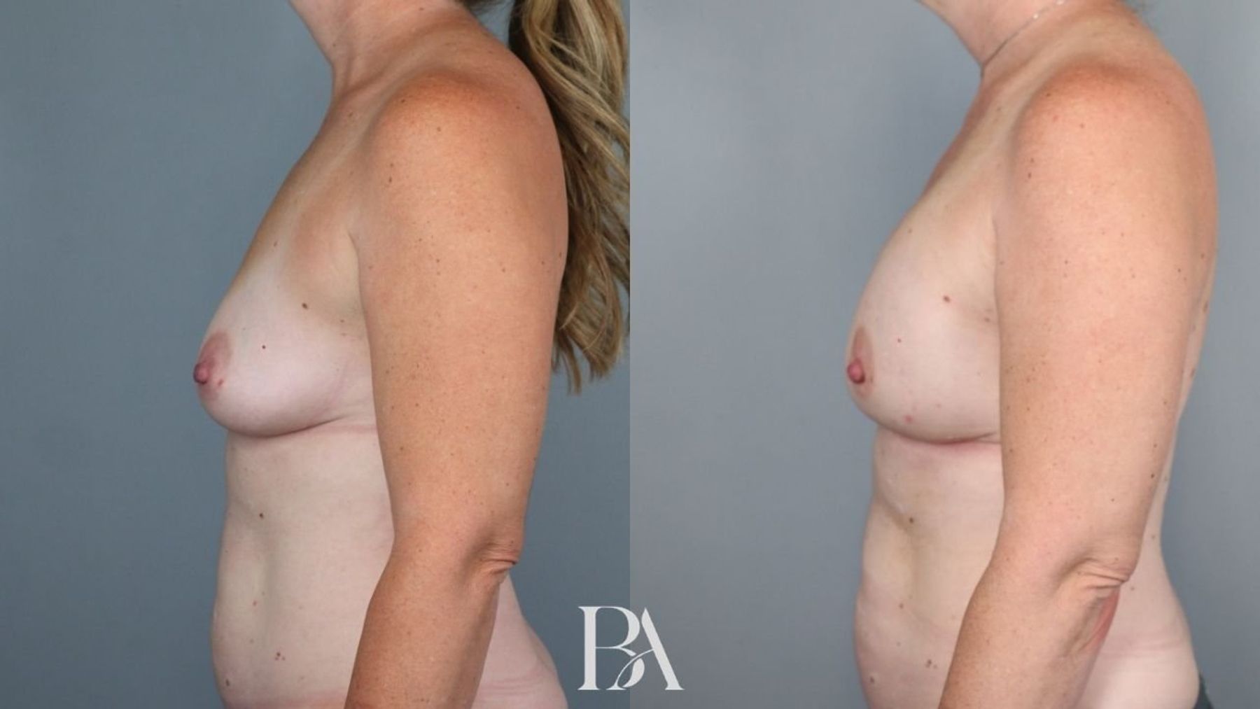 Direct-to-Implant Reconstruction before and after — side view, Dr. Beina Azadgoli, Beverly Hills