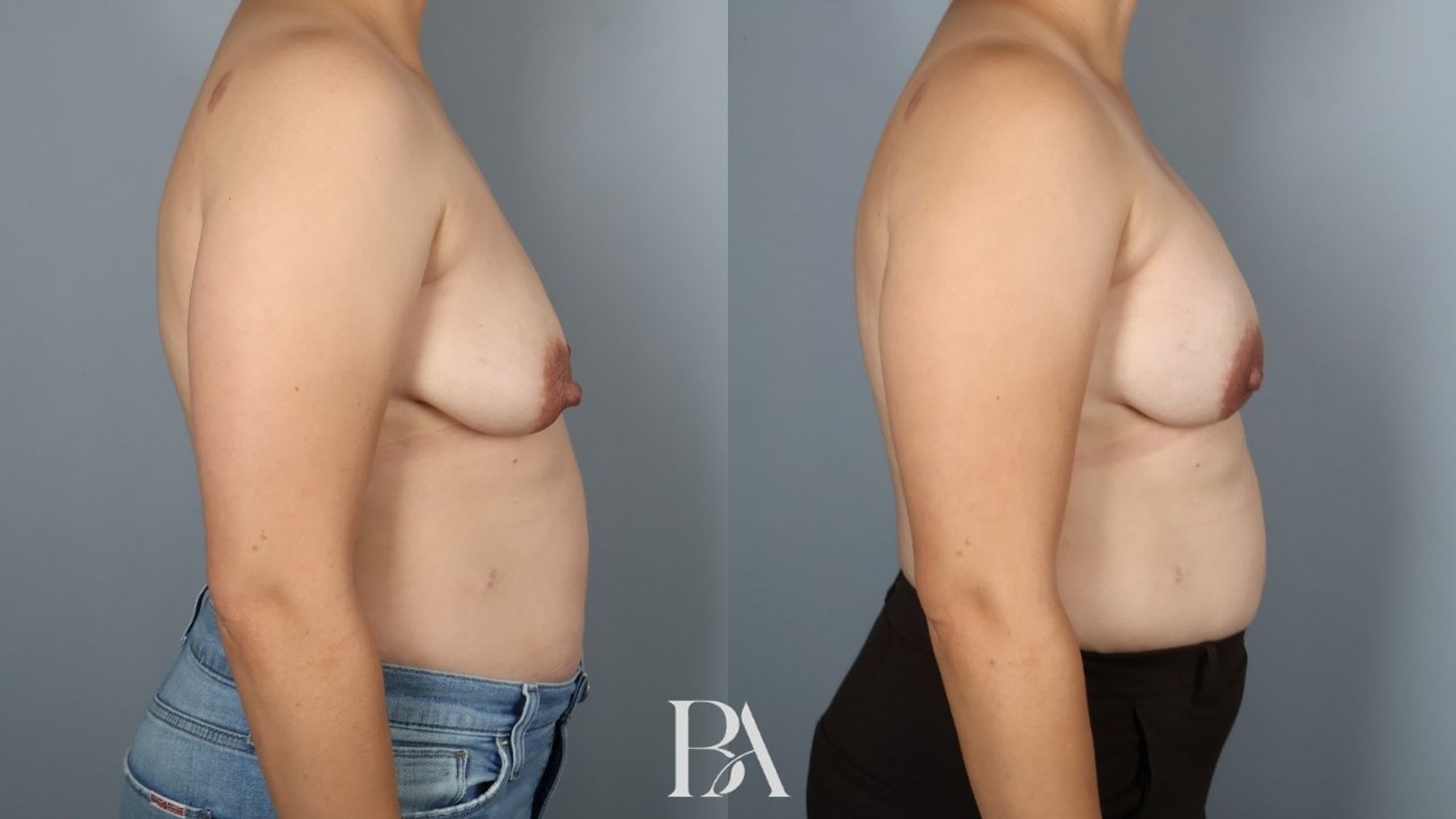 Direct-to-Implant Reconstruction before and after — side view, Dr. Beina Azadgoli, Beverly Hills